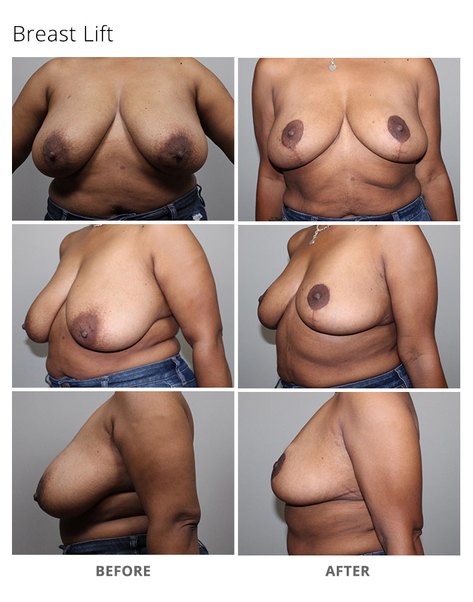 breast lift 6 - Breast Lift