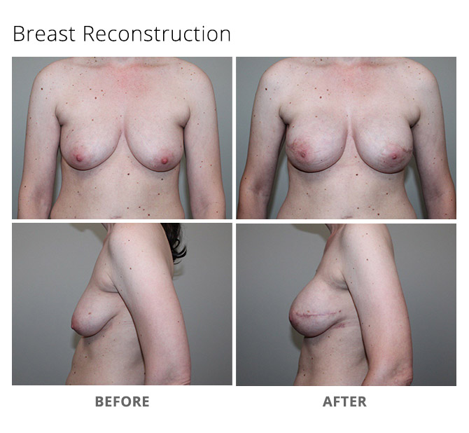 breast reconstruction 10 - Breast Reconstruction