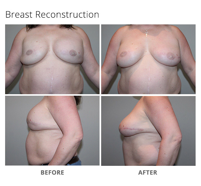 breast reconstruction 11 - Breast Reconstruction