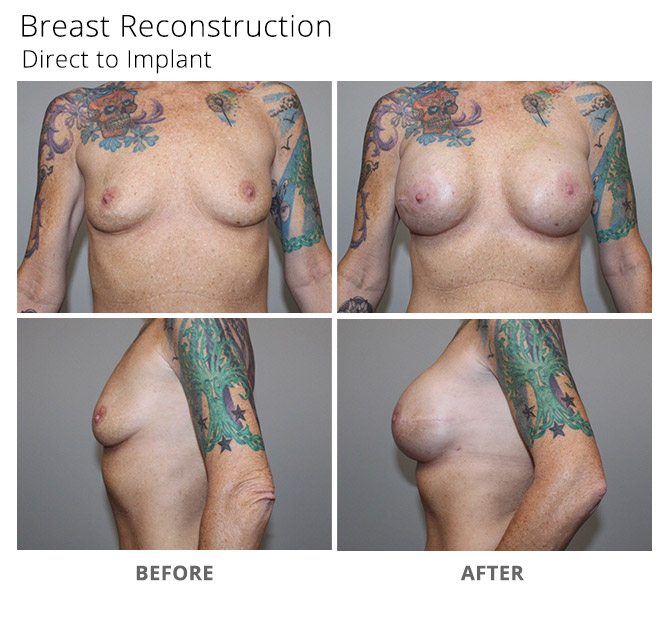 breast reconstruction 12 - Breast Reconstruction