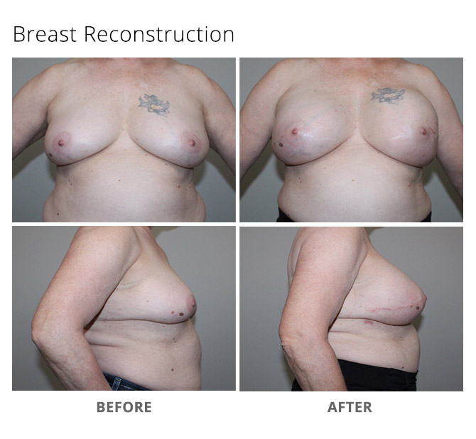 breast reconstruction 14 - Breast Reconstruction