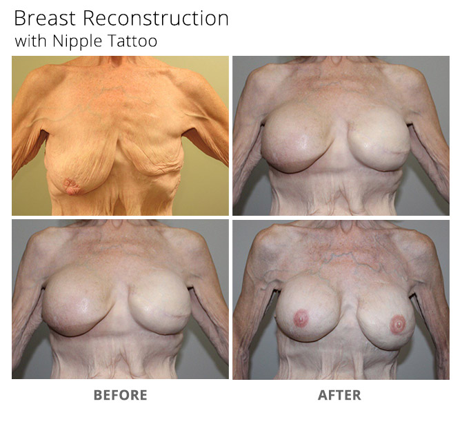breast reconstruction 15 - Breast Reconstruction