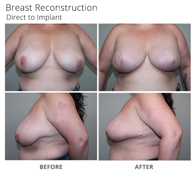 breast reconstruction 17 - Breast Reconstruction