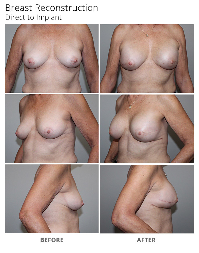 breast reconstruction 18 - Breast Reconstruction