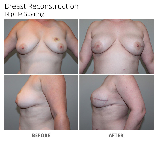 breast reconstruction 19 - Breast Reconstruction