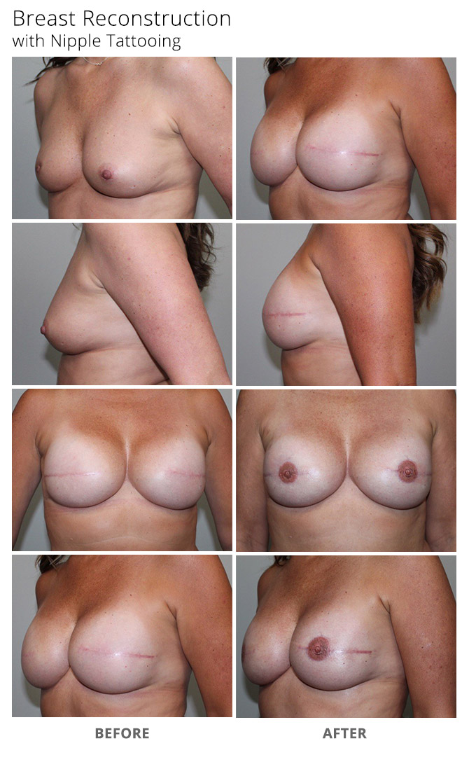breast reconstruction 21 - Breast Reconstruction