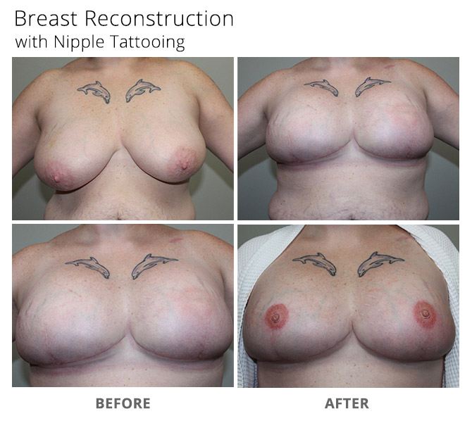breast reconstruction 23 - Breast Reconstruction