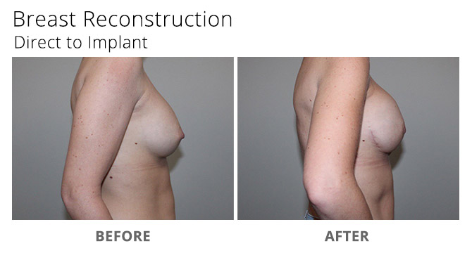 breast reconstruction 9 - Breast Reconstruction