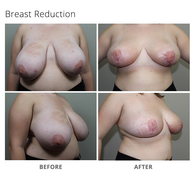breast reduction 15 update - Breast Reduction