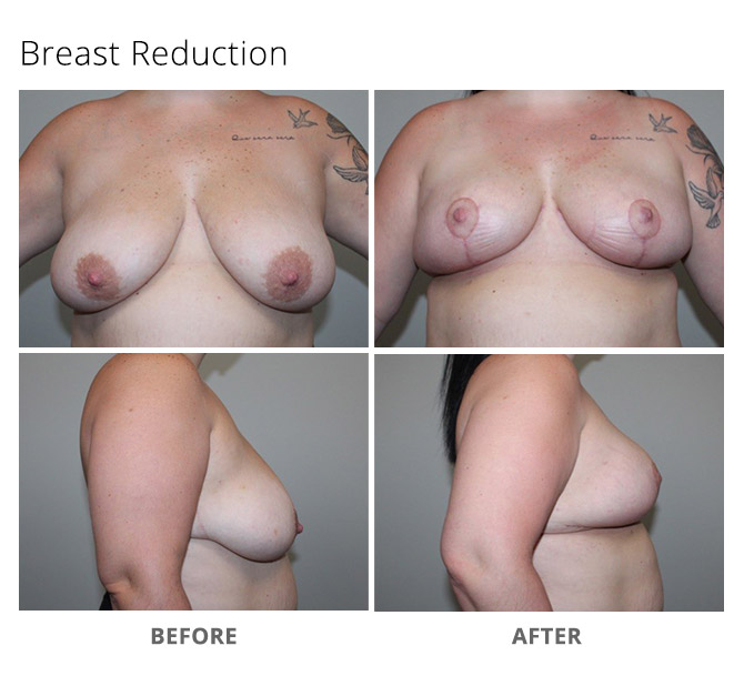breast reduction 17 - Breast Reduction