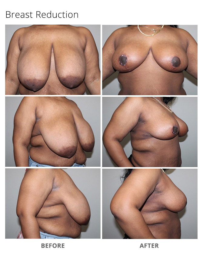 breast reduction 19 - Breast Reduction