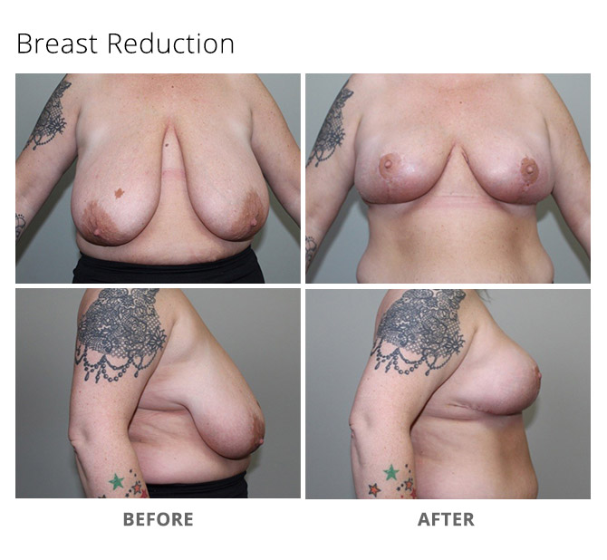 breast reduction 20 - Breast Reduction