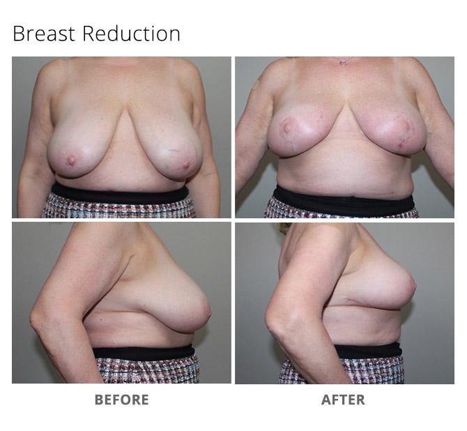 breast reduction 22 - Breast Reduction