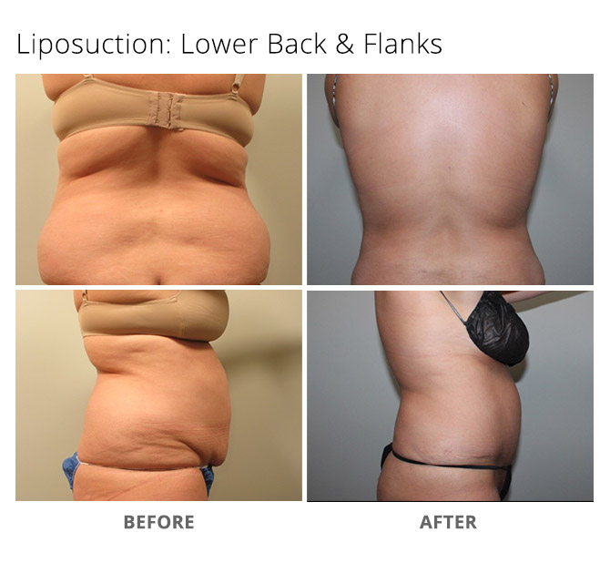 Cost Of Liposuction Austin