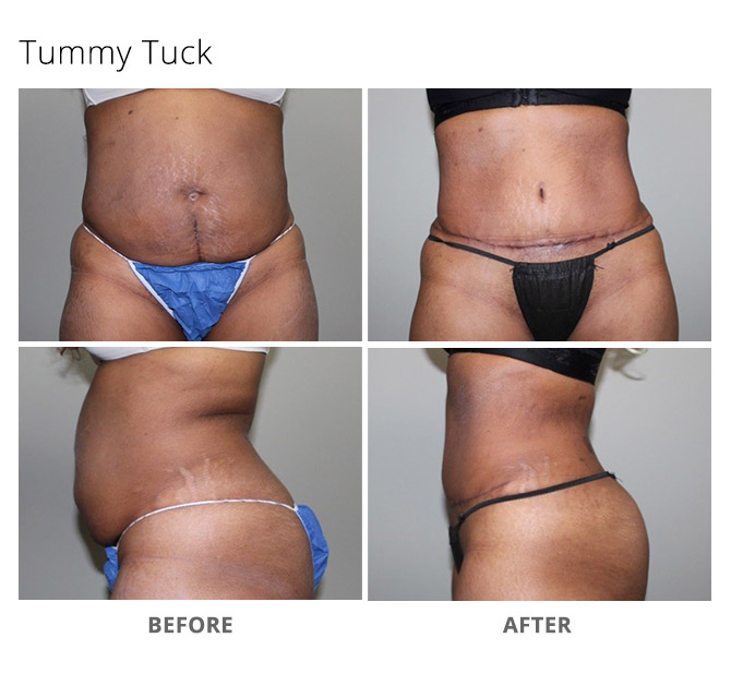 tummy tuck 11 - Tummy Tuck