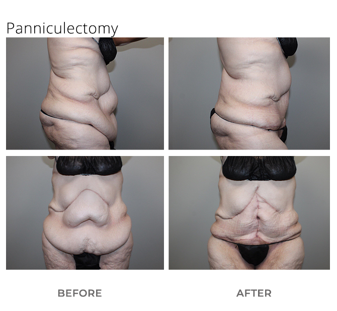 panni - Body Contouring After Weight Loss