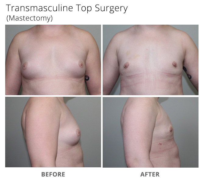 transgender 1 - Transgender Top Surgery
