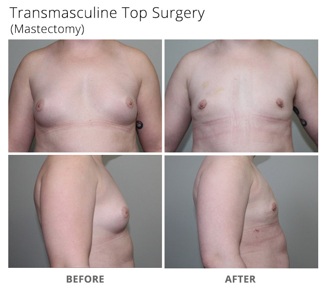 Transgender Female to Male Chest Surgery - Case 01903 - The Plastic Surgery  Group