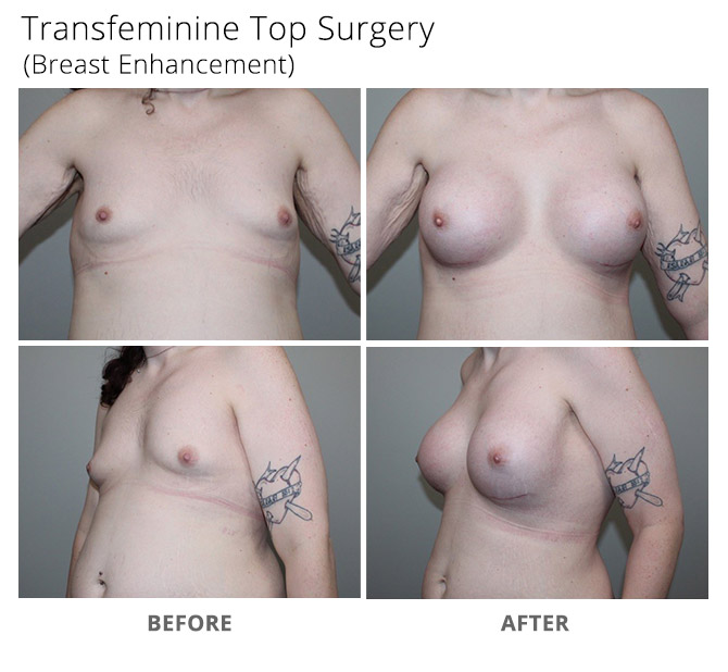 transgender 2 - Transgender Top Surgery