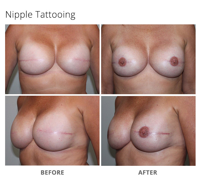 nipple tattooing 5 - Nipple and Areola Tattooing